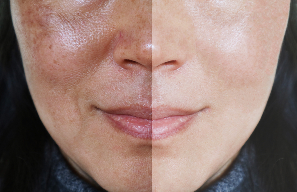 Melasma is a dark skin discoloration, appearing in sun exposed areas. On the face it mostly affects the cheeks and the nose; it manifests as well demarcated hyper pigmented patches