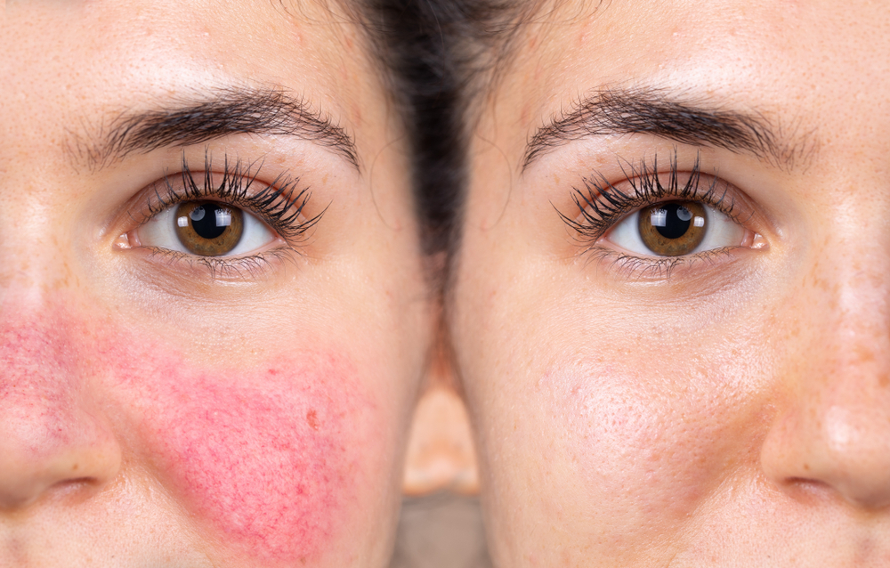 Rosacea is a very common condition. It predominantly affects middle aged women with a fair skin complexion. It manifests as redness and visible capillaries, predominantly on the cheeks and around the nose. With time the skin in the affected areas become thicker, especially on the nose.
