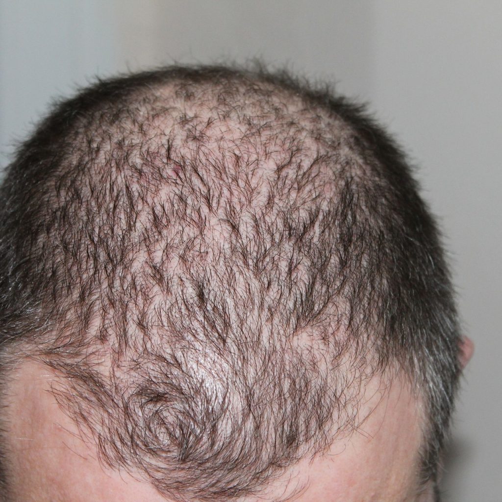 hair loss affects a large volume of the population and can be impacting on self esteem