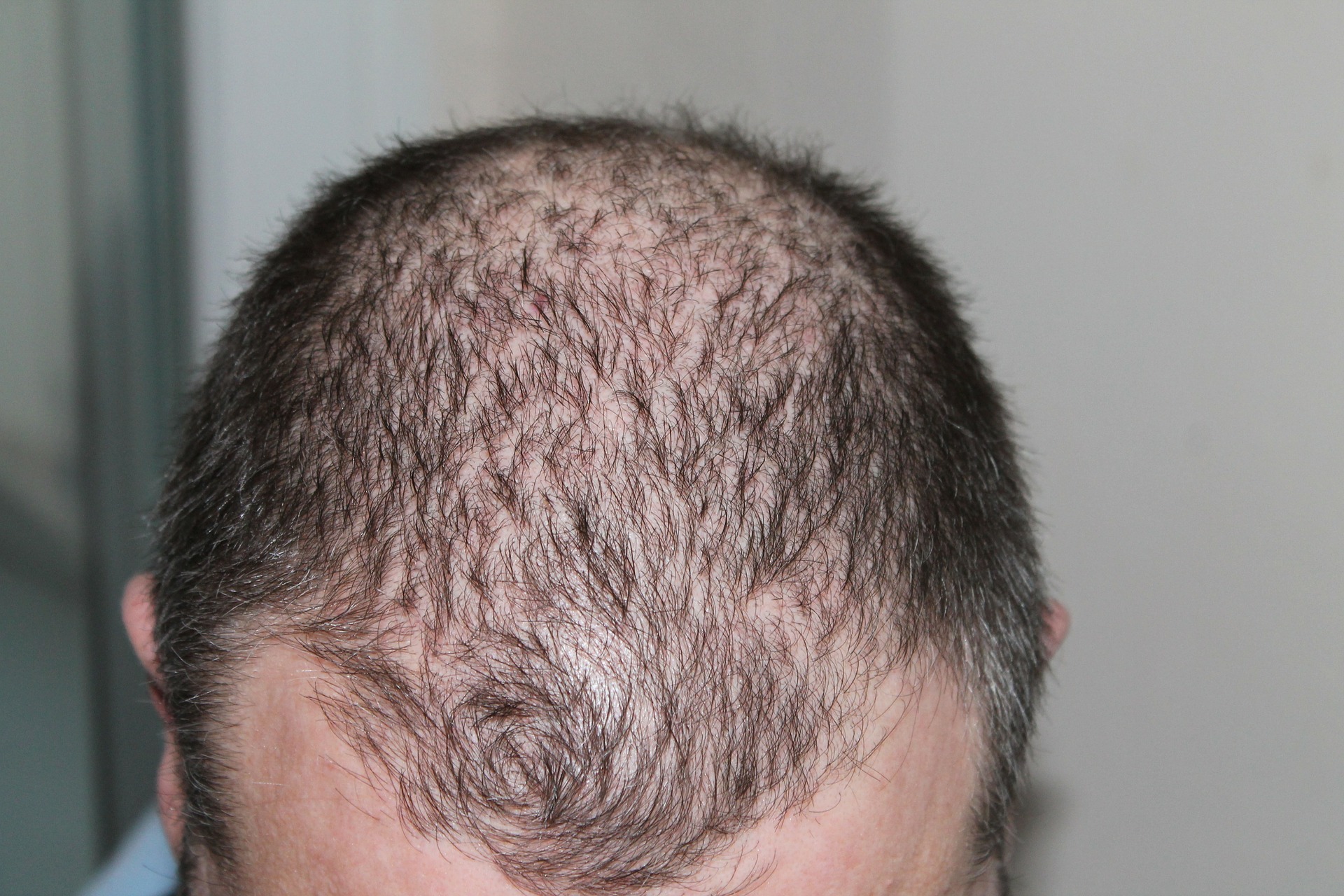 hair loss affects a large volume of the population and can be impacting on self esteem