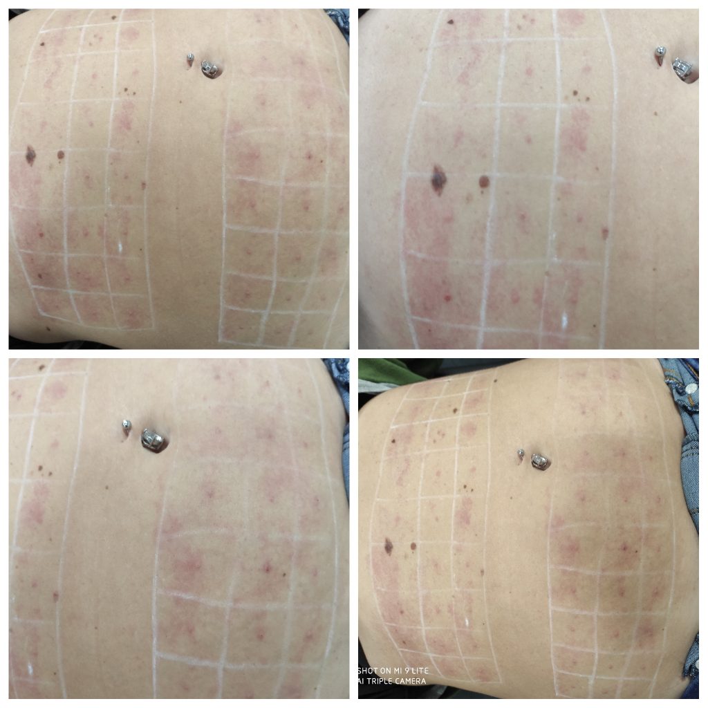 Fat dissolving injections over upper and lower abdomen.