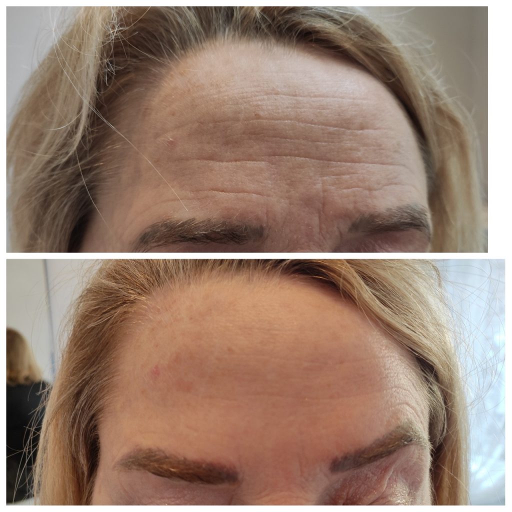 Forehead lines softening with anti wrinkles injections in a patient with mature skin.