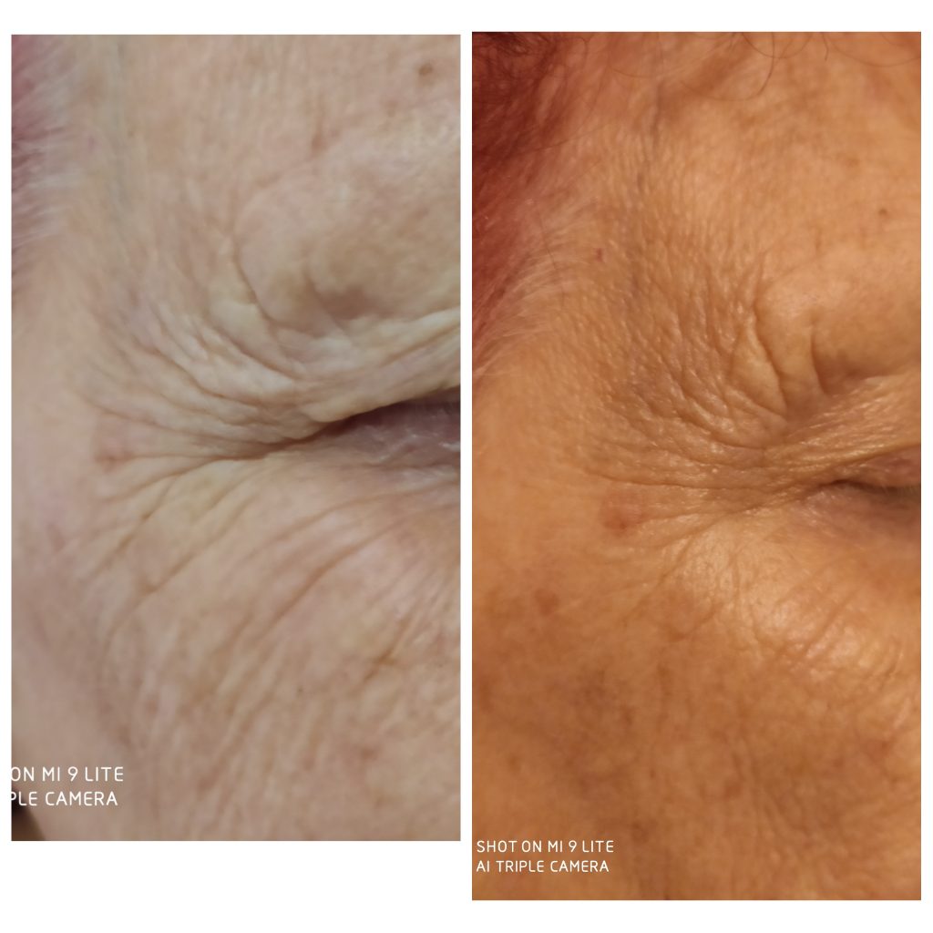 Crows feet softening with anti wrinkles injections with neuromodulators