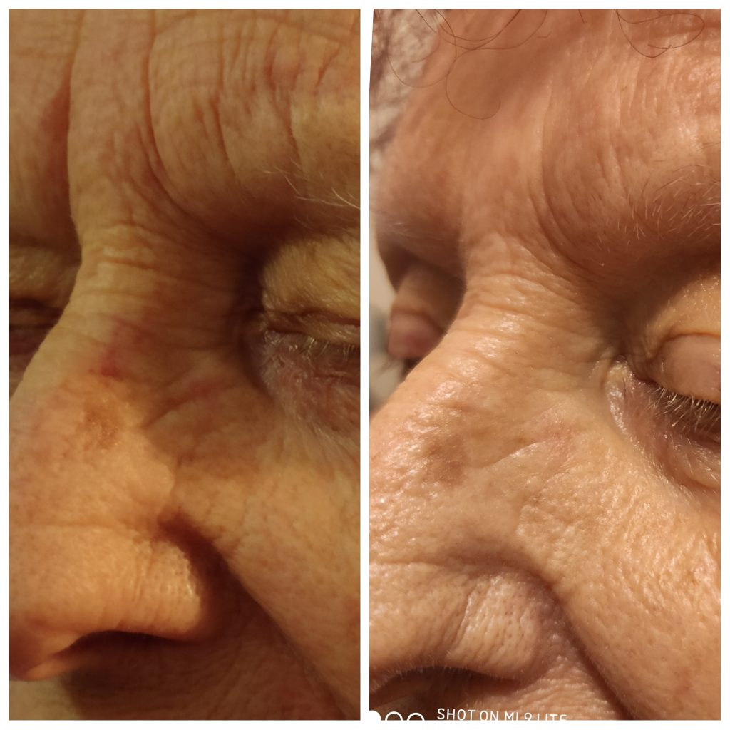 Frown lines and bunny lines softening with anti wrinkles injections with neuromodulators