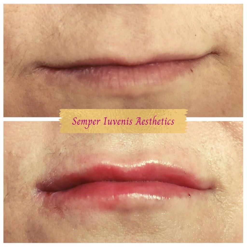 Lips contouring in a subject with very thin lips and residual scarring from Herpes zoster lesions