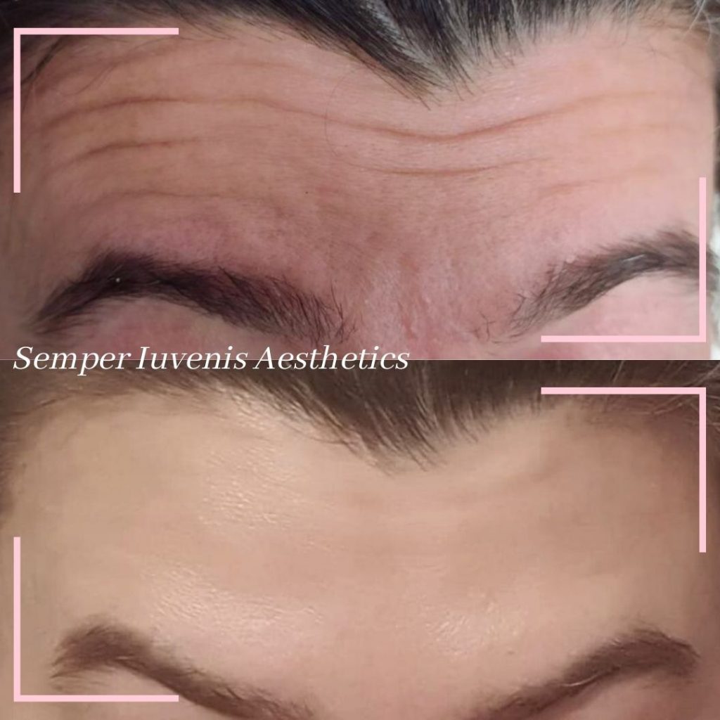 Forehead lines softening with anti wrinkles injections with great results