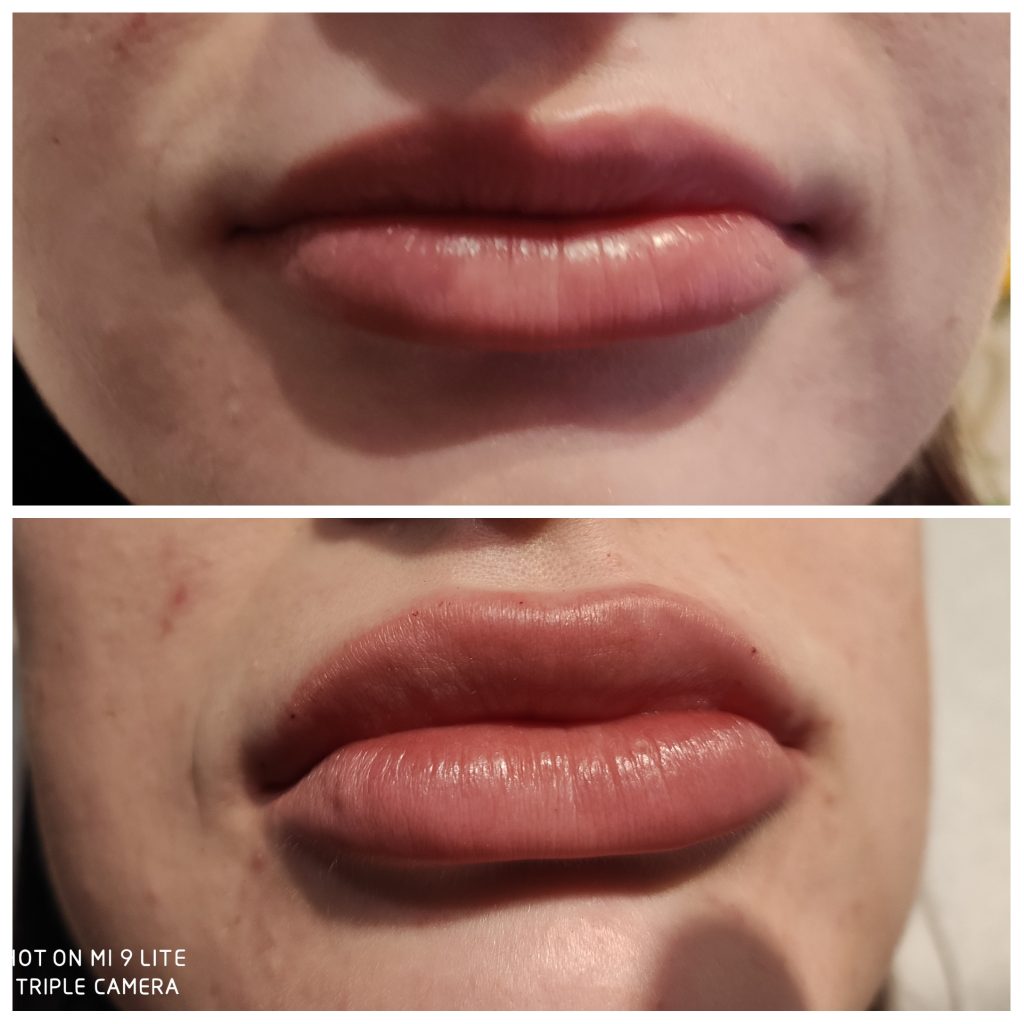 Lips augmentation ad contouring can be safely achieved with the injection of dermal fillers.