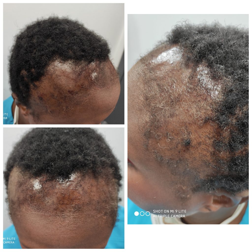 Hair loss is treatable with combination therapy of PRP and Mesotherapy injections