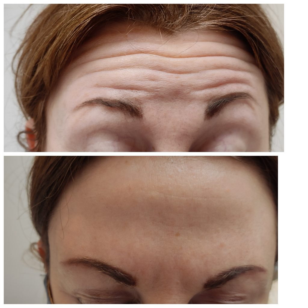 Forehead lines smoothing with anti wrinkles injections
