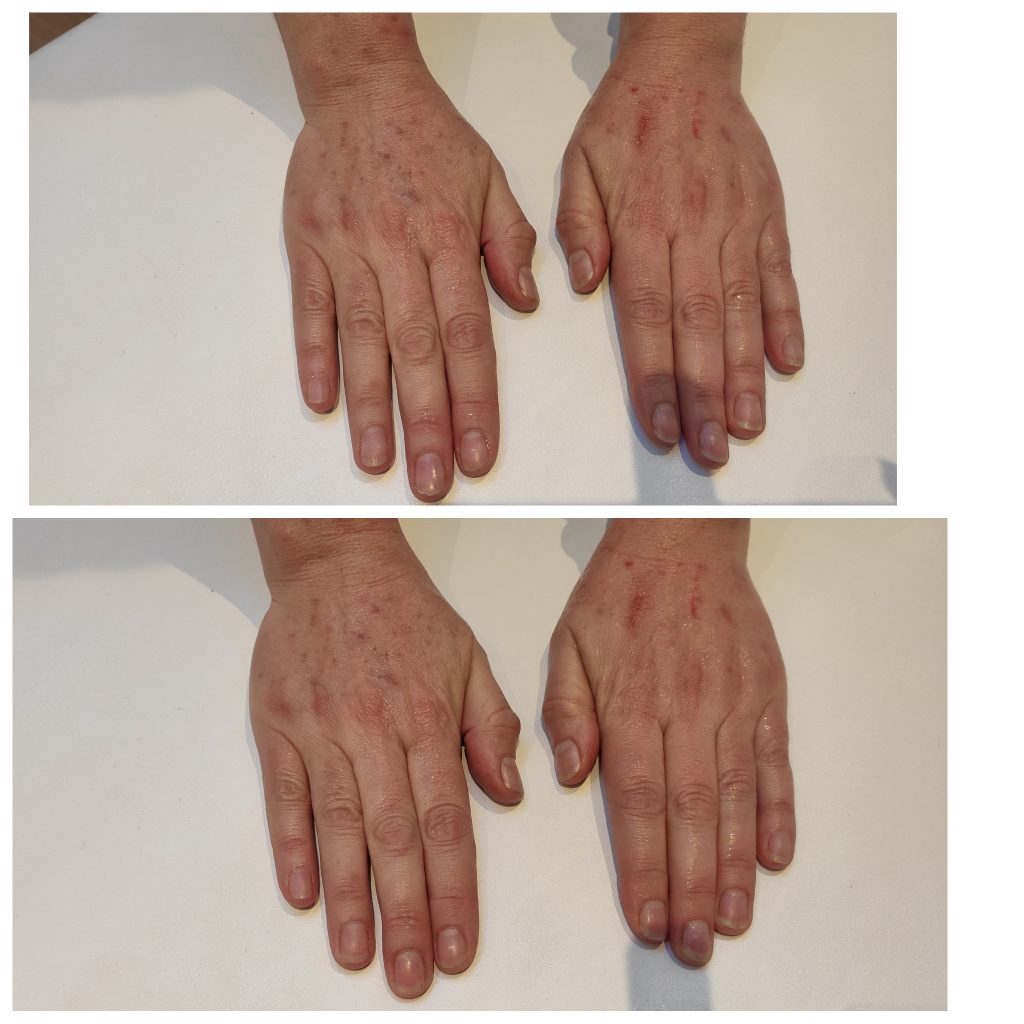 With ageing hands loose volume and develop pigmentation. Microneedling with PRP can soften the appearance of sun spots and fine lines and srinkles