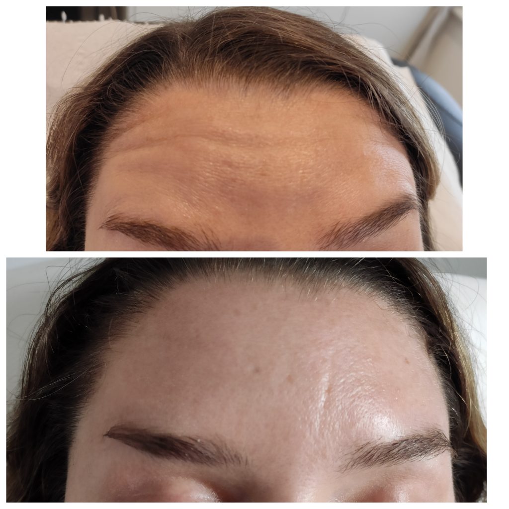 Forehead lines softening with anti wrinkles injections with Botulinum toxin