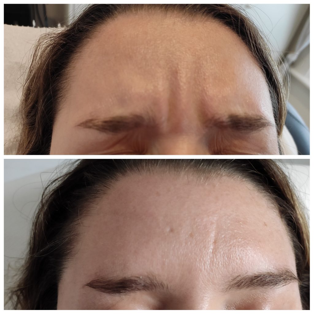 Frown lines softening with anti wrinkles injections with Botulinum toxin