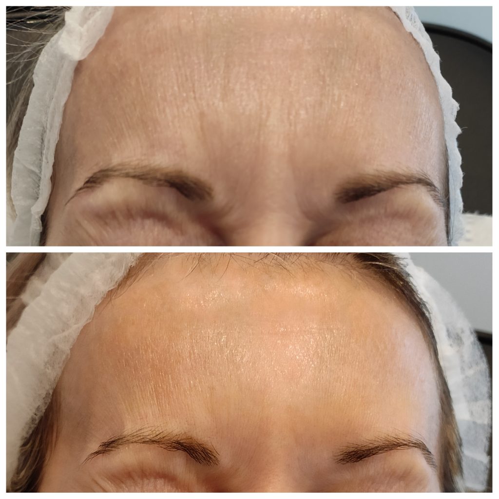 Frown lines softening with anti wrinkles injections with Botuilnum toxin