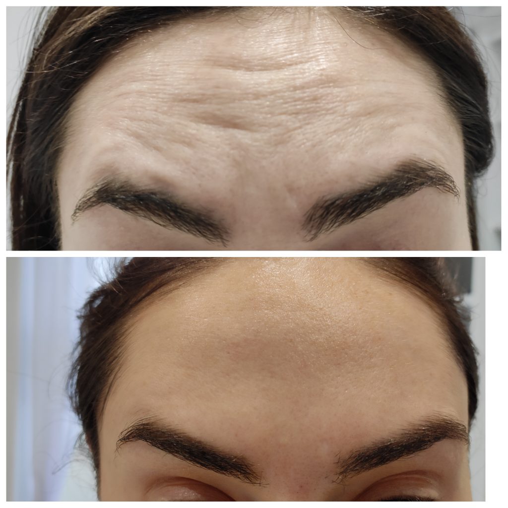 Forehead lines softening with antiwrinkles injections with Botulinum toxin