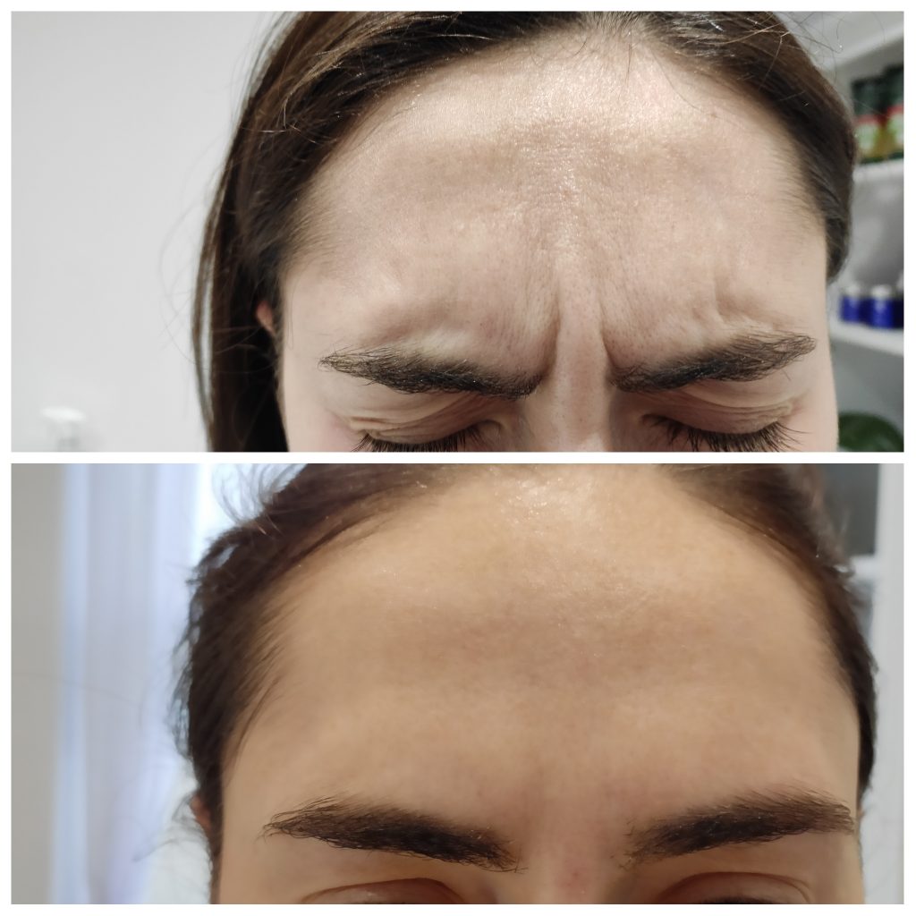 Frown lines softening with antiwrinkles injections