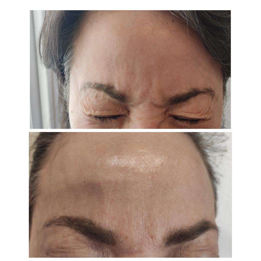 Frown lines softening with anti wrinkles injections with Botulinum toxin