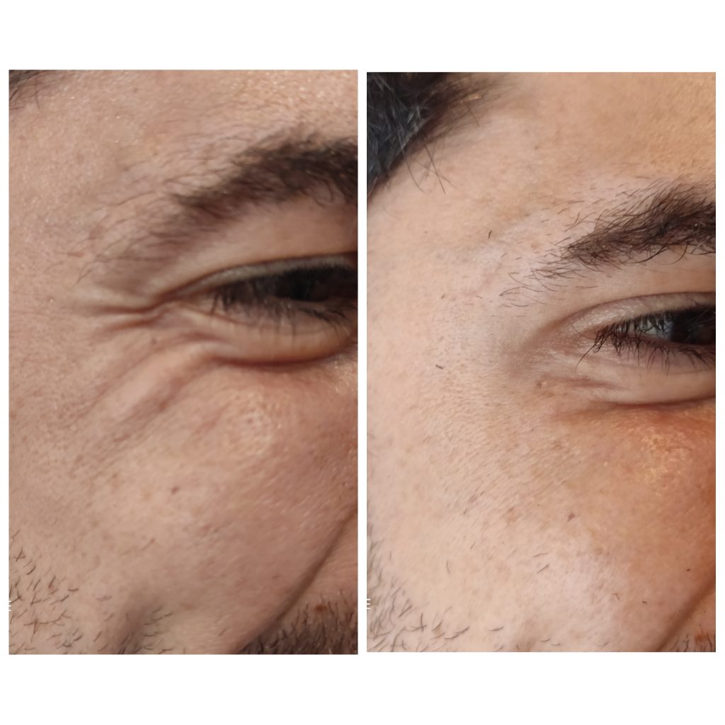 Crows feet softening in a male patient with anti wrinkles injections