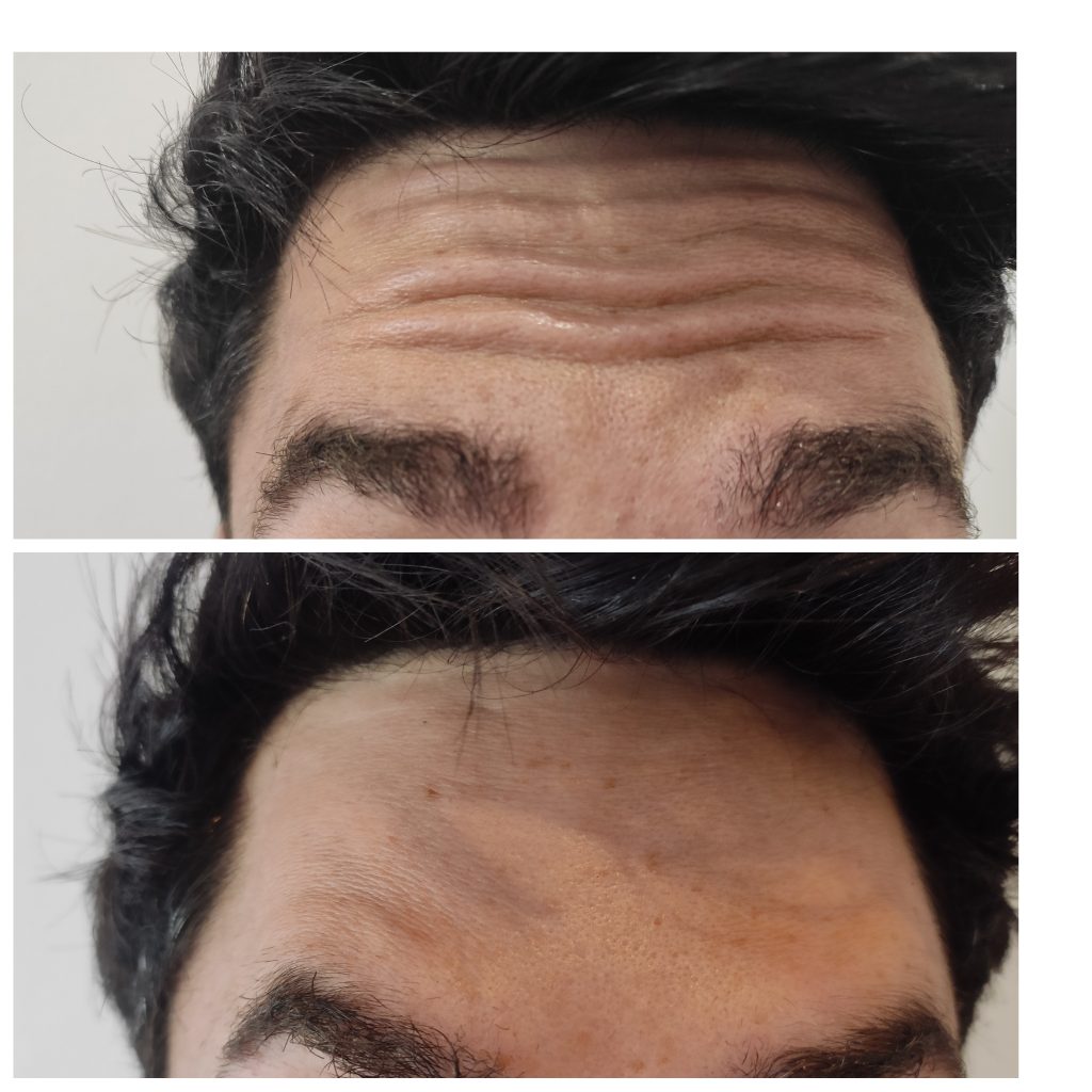 Forehead lines softening with anti wrinkles injections with neuromodulators