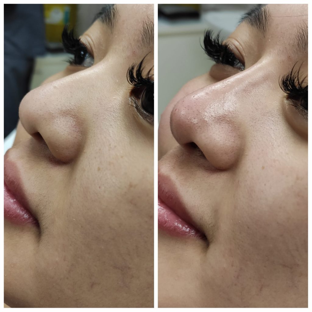 Dermal fillers are a very effective and minimally invasive way of correcting a defect, reshaping and contouring your nose. Results are immediately visible, right after the treatment, with the best aesthetic results achieved 2-3 weeks after treatment, once the filler has been integrated with the rest of the facial tissue. Liquid rhinoplasty is a great alternative to surgery in terms of downtime and costs.
