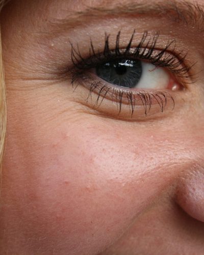 Crow’s feet are wrinkles that appear in the lateral corner of the eyes.They are due to loss in skin elasticity due to a reduced production of collagen.The formation of wrinkles in this area is multifactorial.Main contributing factors are ageing, repeated unprotected sun exposure, smoking, poor hydration, exposure to the cold, alcohol.They can present in the form of superficial dynamic lines or deep static lines.