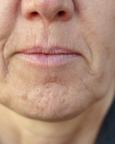 Poppy chin or dimply chin is a very common condition, caused by uneven contraction of the chin muscles. It manifests with wrinkles and a “poppy” appearance of the chin.It’s associated with ageing in both men and women.