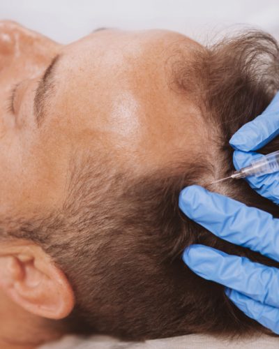 Platelets contain plenty of growth factors, when injected in the scalp stimulate hair growth